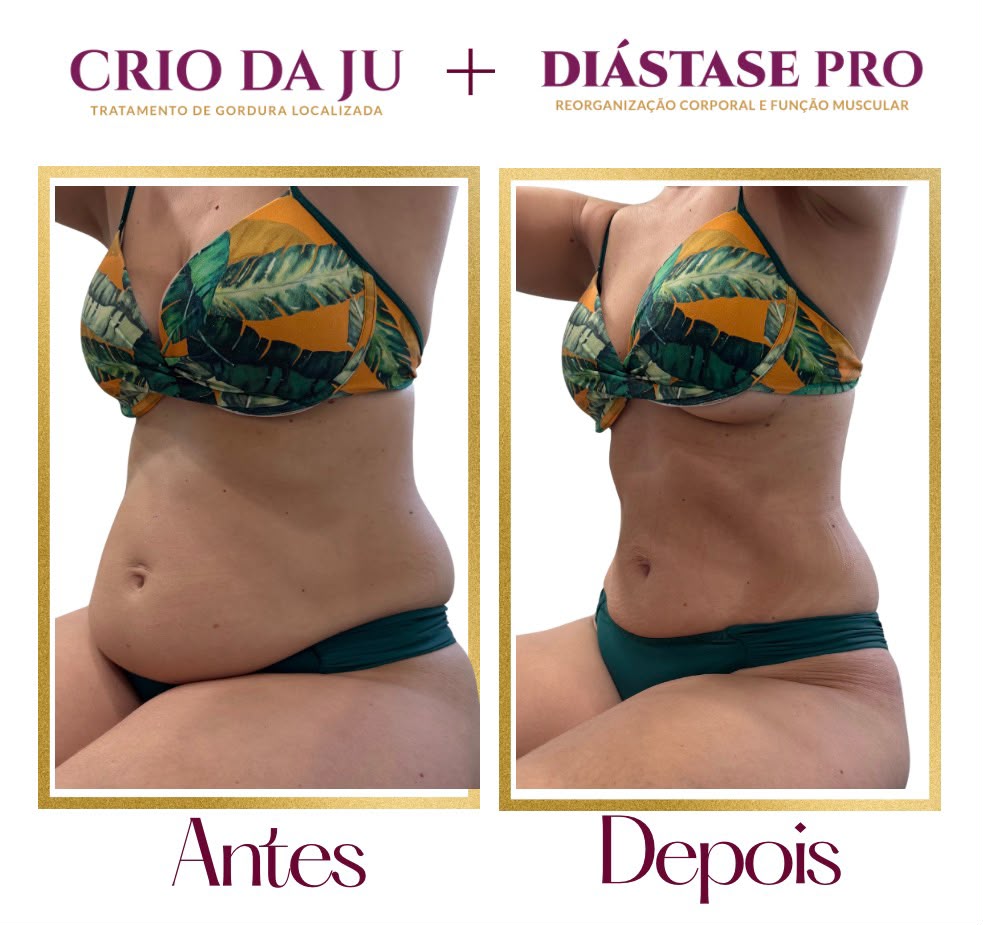 O Programa Diástase Pro foi desenvolvido para você que passou por uma gestação ou não - foto 1