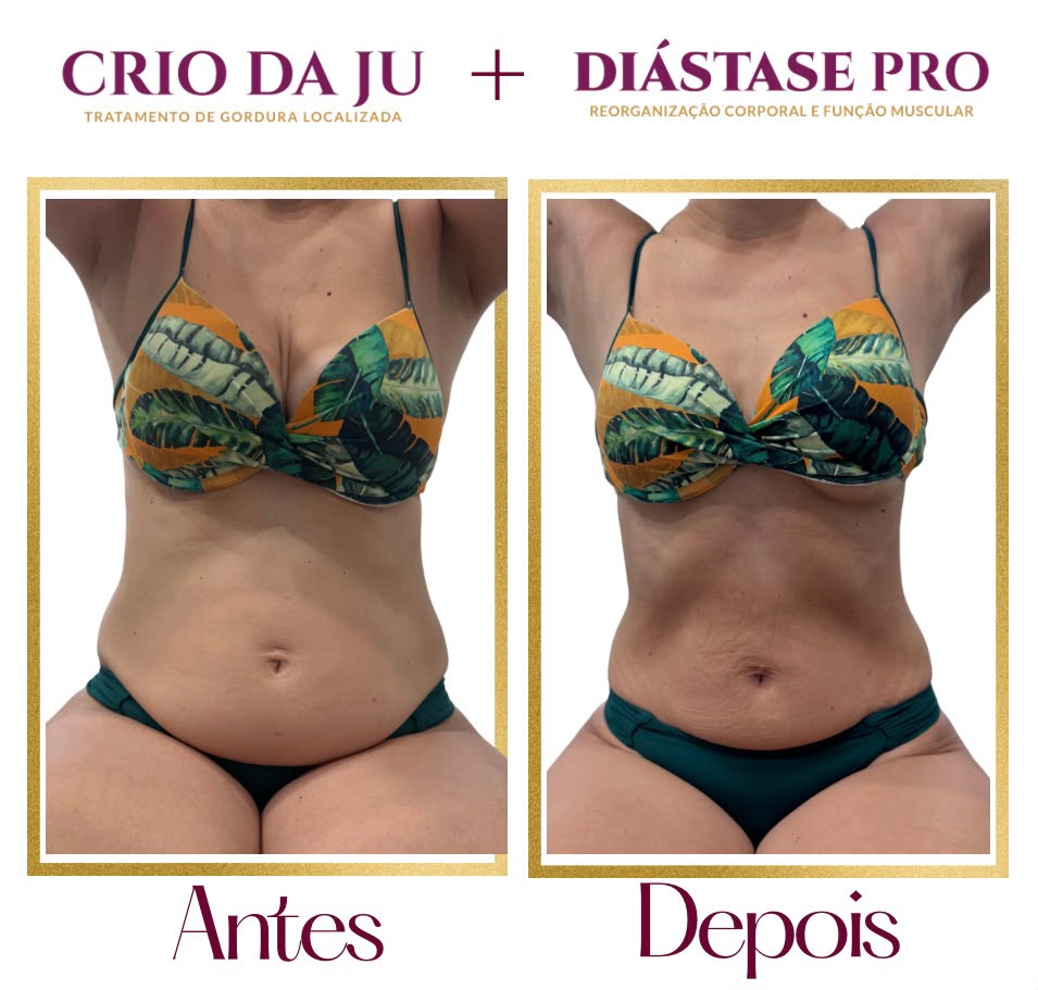 O Programa Diástase Pro foi desenvolvido para você que passou por uma gestação ou não - foto 2