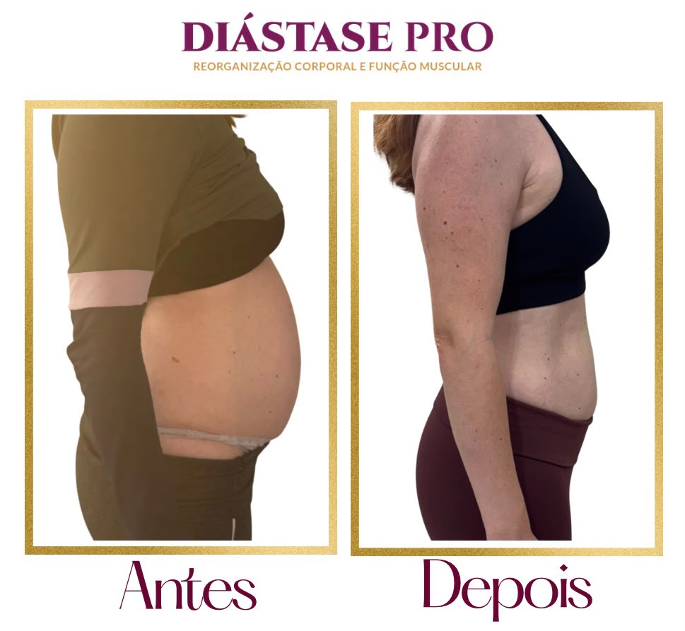 O Programa Diástase Pro foi desenvolvido para você que passou por uma gestação ou não - foto 6
